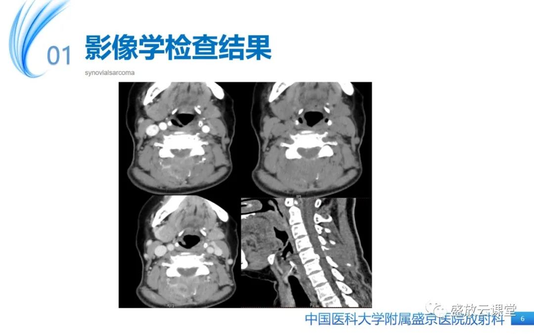 影像PPT - 【PPT】滑膜肉瘤-6