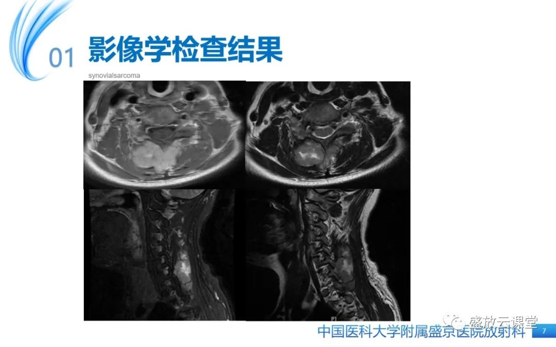 影像PPT - 【PPT】滑膜肉瘤-7