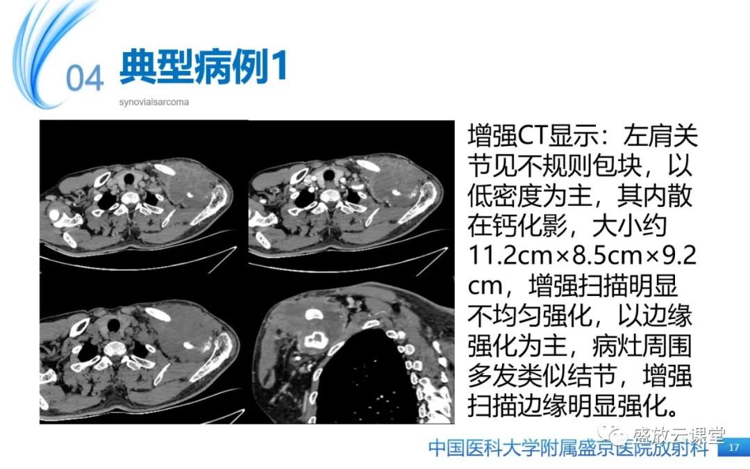 影像PPT - 【PPT】滑膜肉瘤-16
