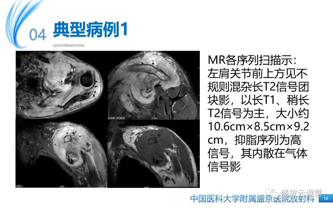 影像PPT - 【PPT】滑膜肉瘤-17