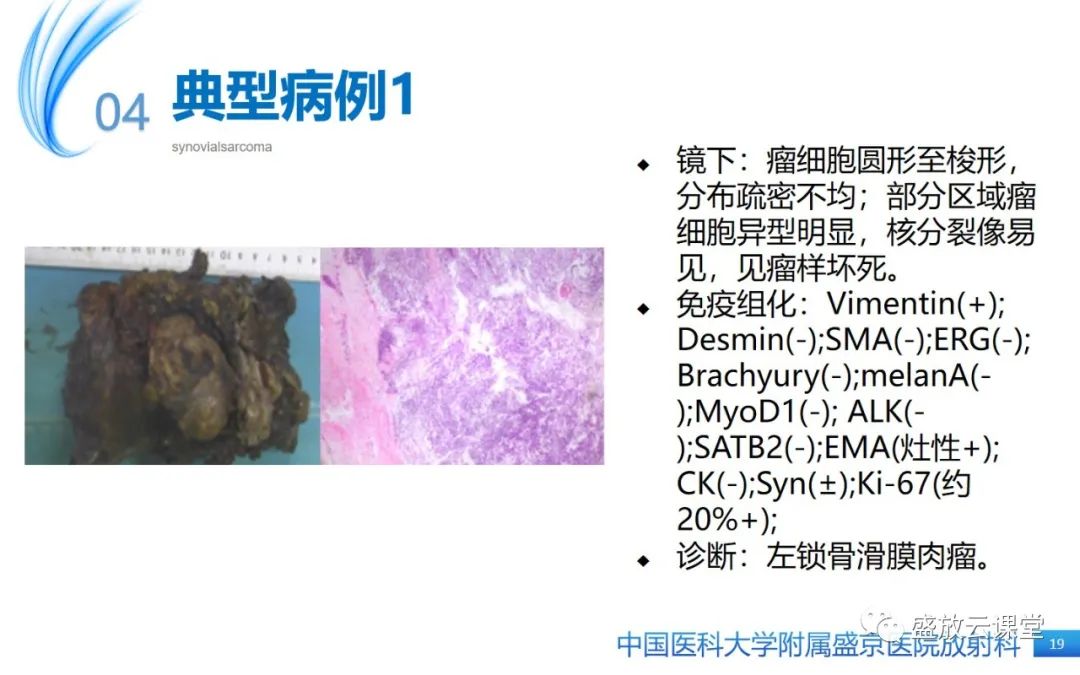 影像PPT - 【PPT】滑膜肉瘤-18