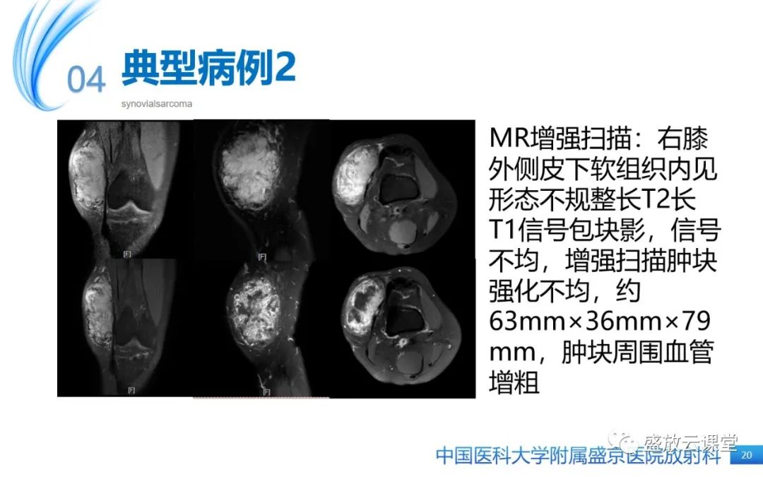 影像PPT - 【PPT】滑膜肉瘤-19