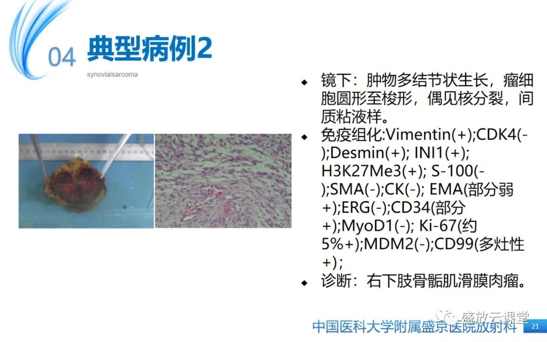 影像PPT - 【PPT】滑膜肉瘤-20