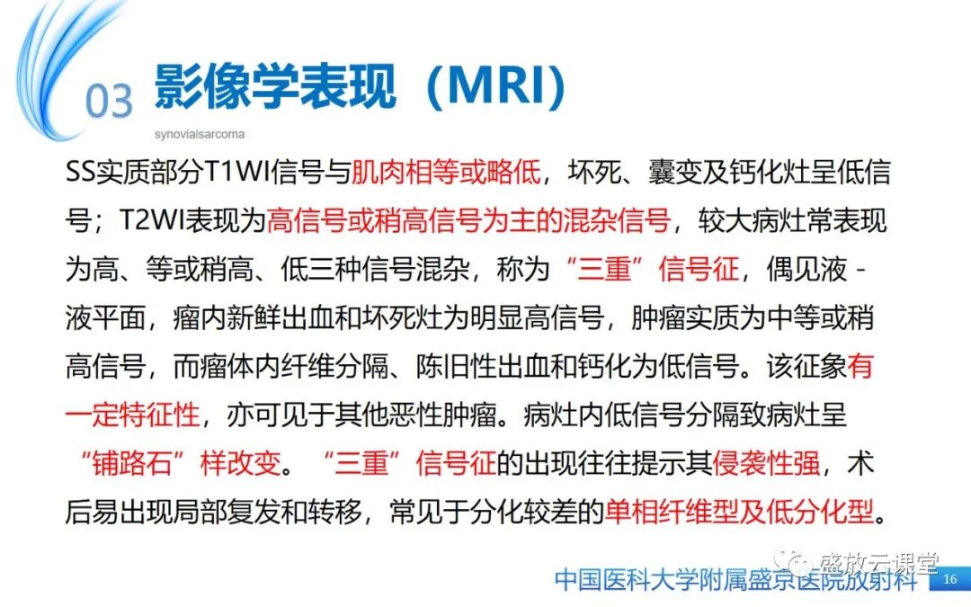 影像PPT - 【PPT】滑膜肉瘤-15