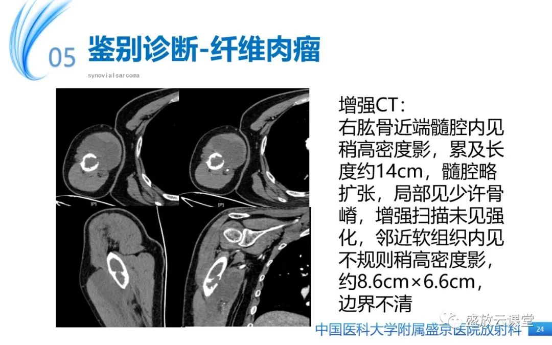 影像PPT - 【PPT】滑膜肉瘤-23