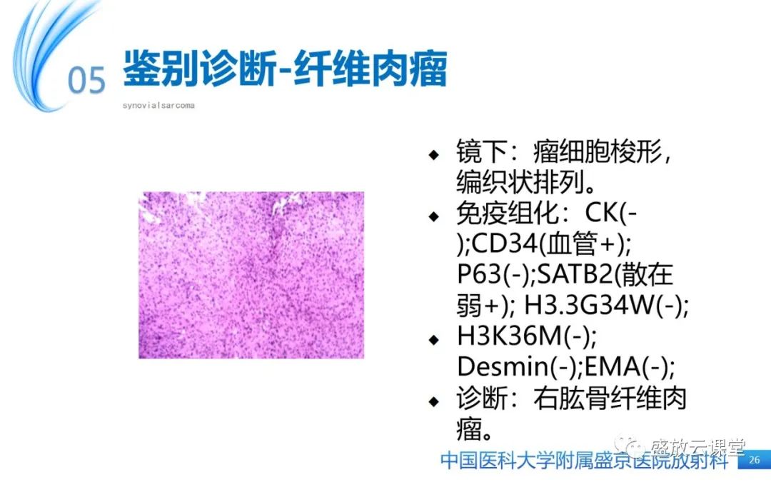 影像PPT - 【PPT】滑膜肉瘤-25