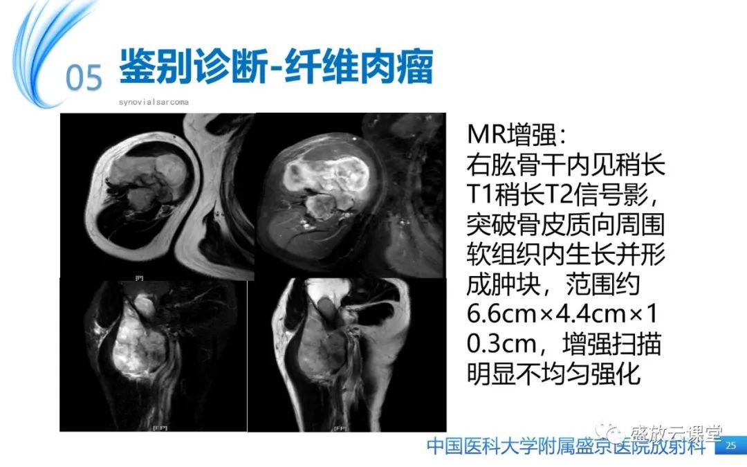 影像PPT - 【PPT】滑膜肉瘤-24