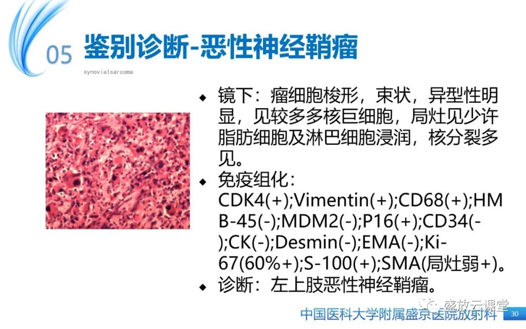影像PPT - 【PPT】滑膜肉瘤-29
