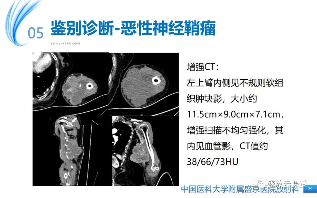 影像PPT - 【PPT】滑膜肉瘤-28