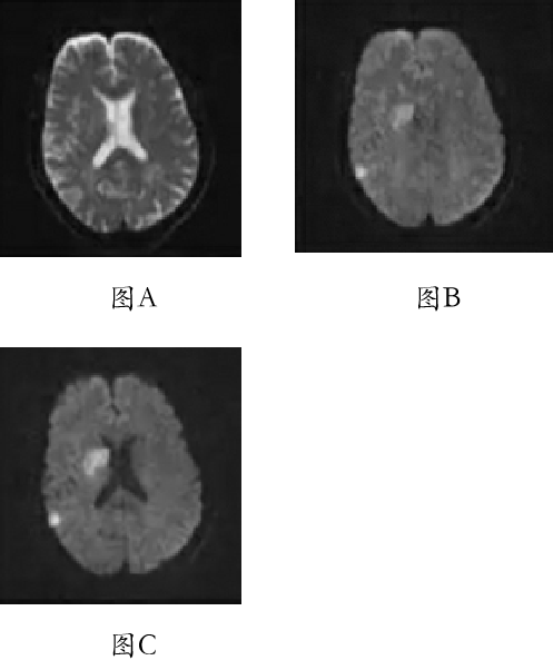 影像PPT - DWI、PWI在缺血性脑卒中上的应用以及联合应用对临床治疗方式选择的指导意义-2 影像PPT - DWI、PWI在缺血性脑卒中上的应用以及联合应用对临床治疗方式选择的指导意义-2