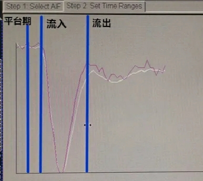 影像PPT - DWI、PWI在缺血性脑卒中上的应用以及联合应用对临床治疗方式选择的指导意义-10 影像PPT - DWI、PWI在缺血性脑卒中上的应用以及联合应用对临床治疗方式选择的指导意义-10
