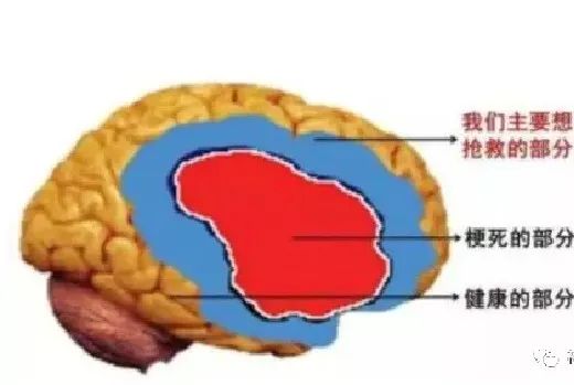 影像PPT - DWI、PWI在缺血性脑卒中上的应用以及联合应用对临床治疗方式选择的指导意义-15 影像PPT - DWI、PWI在缺血性脑卒中上的应用以及联合应用对临床治疗方式选择的指导意义-15