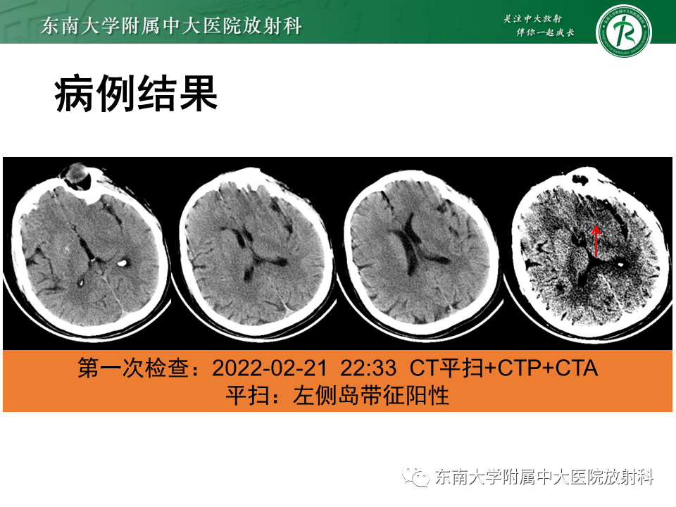 影像PPT - 【PPT】急性缺血性脑卒中的多模态CT评估-6