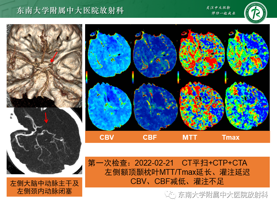 影像PPT - 【PPT】急性缺血性脑卒中的多模态CT评估-7