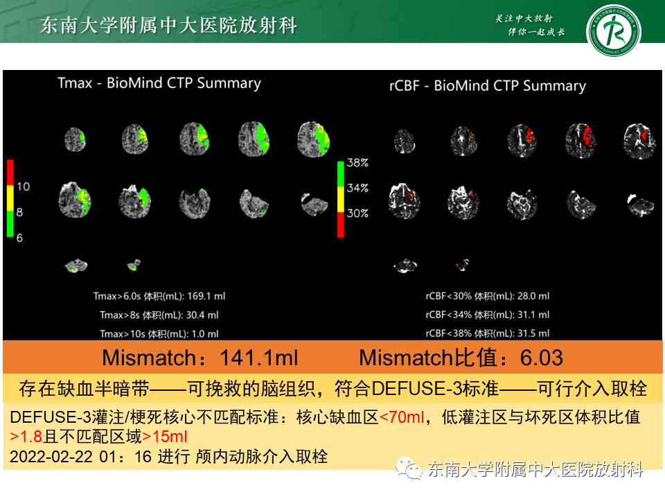 影像PPT - 【PPT】急性缺血性脑卒中的多模态CT评估-8
