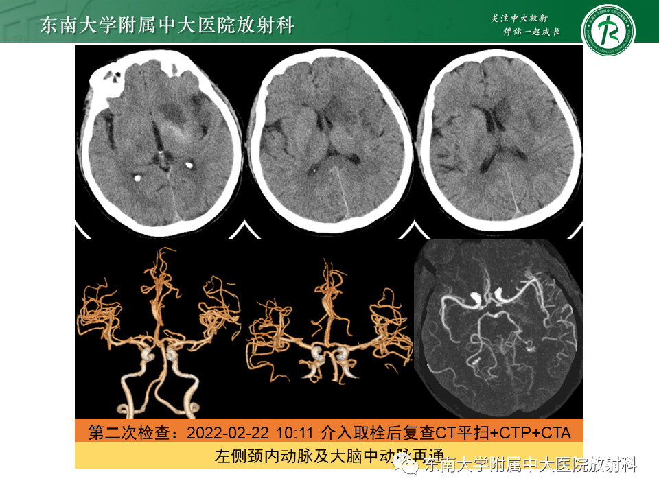 影像PPT - 【PPT】急性缺血性脑卒中的多模态CT评估-9