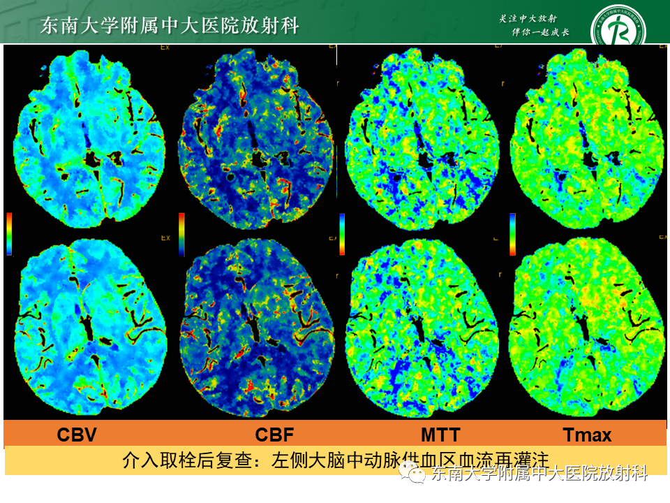 影像PPT - 【PPT】急性缺血性脑卒中的多模态CT评估-10