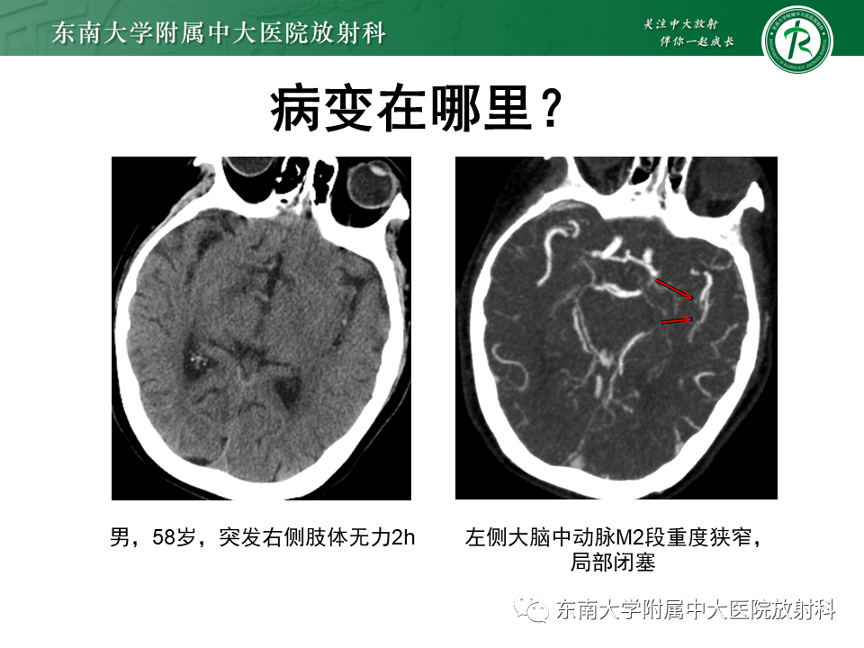 影像PPT - 【PPT】急性缺血性脑卒中的多模态CT评估-23