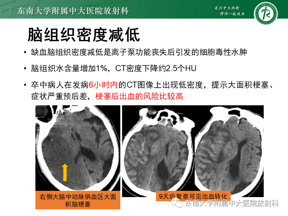 影像PPT - 【PPT】急性缺血性脑卒中的多模态CT评估-24