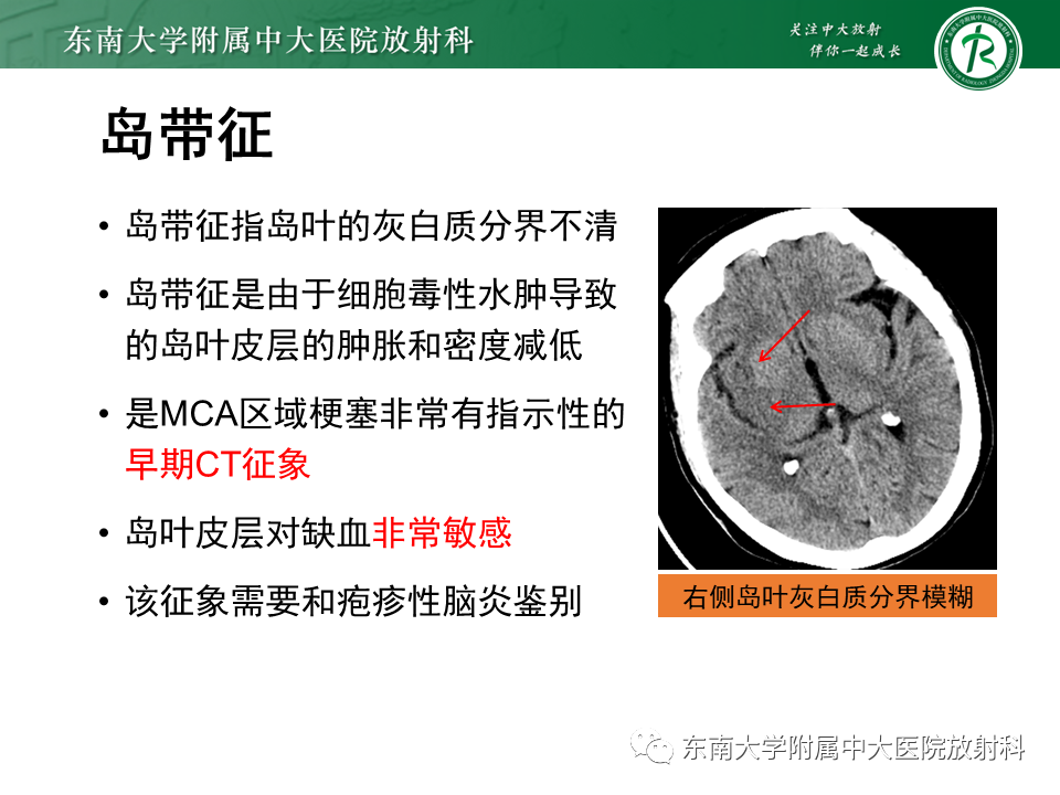 影像PPT - 【PPT】急性缺血性脑卒中的多模态CT评估-26