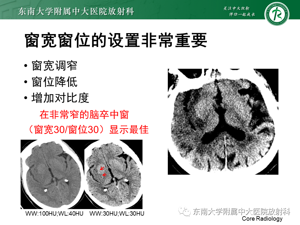 影像PPT - 【PPT】急性缺血性脑卒中的多模态CT评估-27
