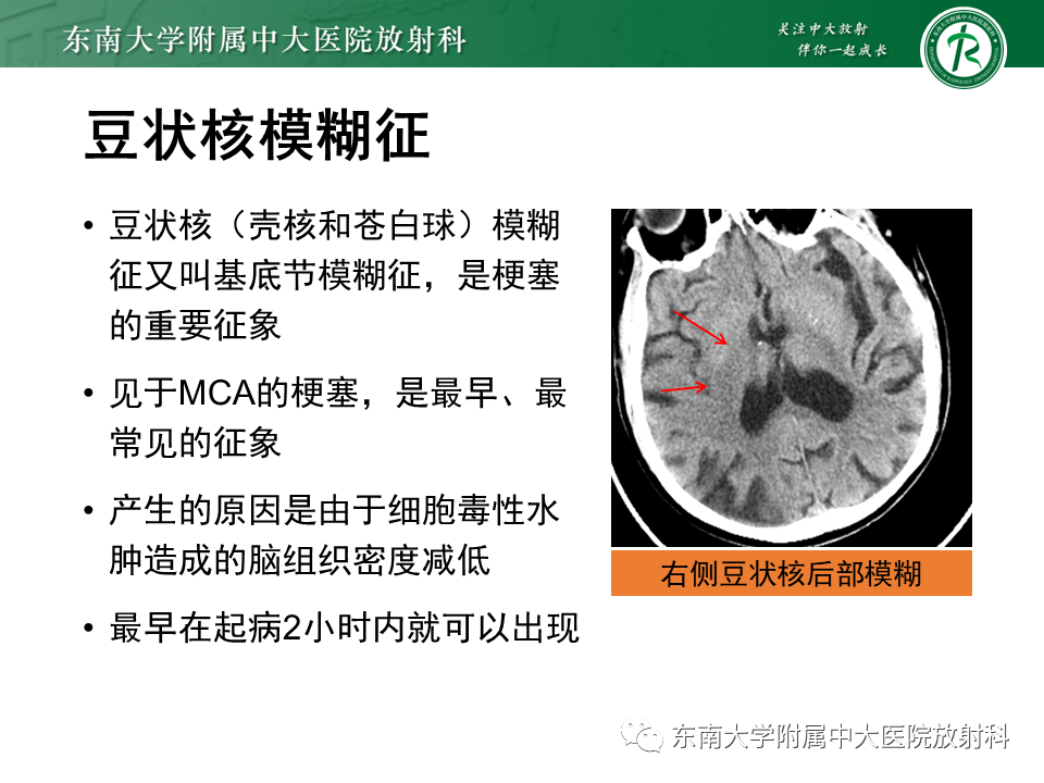影像PPT - 【PPT】急性缺血性脑卒中的多模态CT评估-25