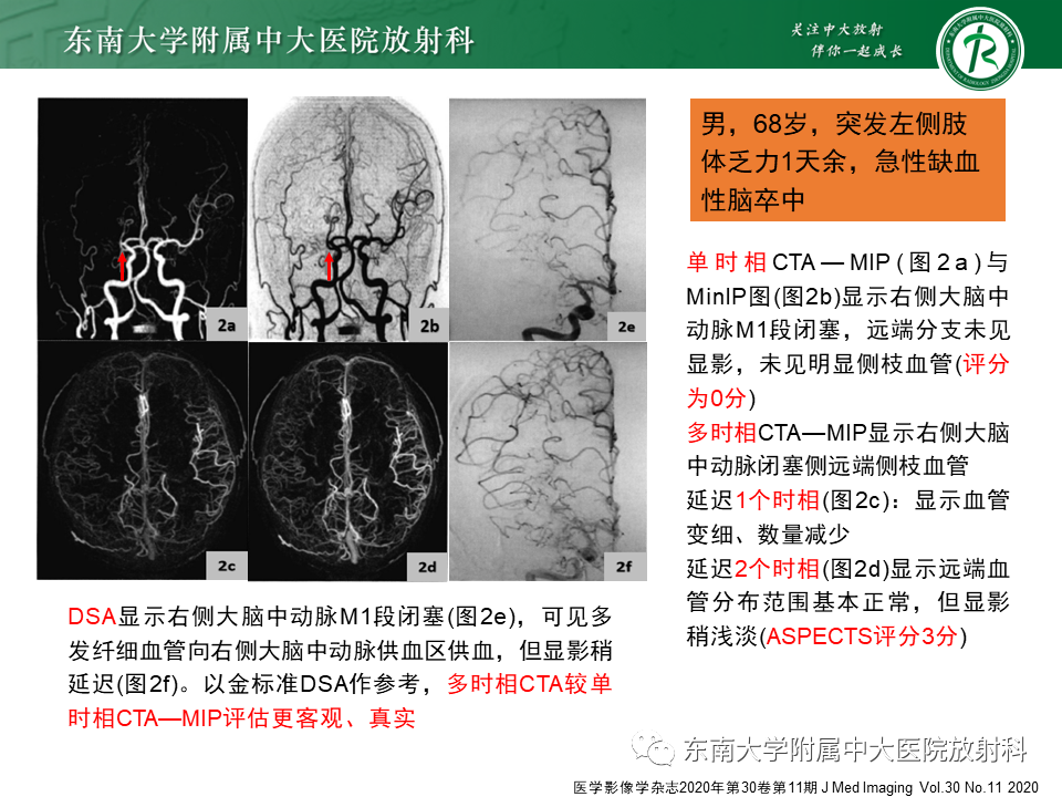 影像PPT - 【PPT】急性缺血性脑卒中的多模态CT评估-33