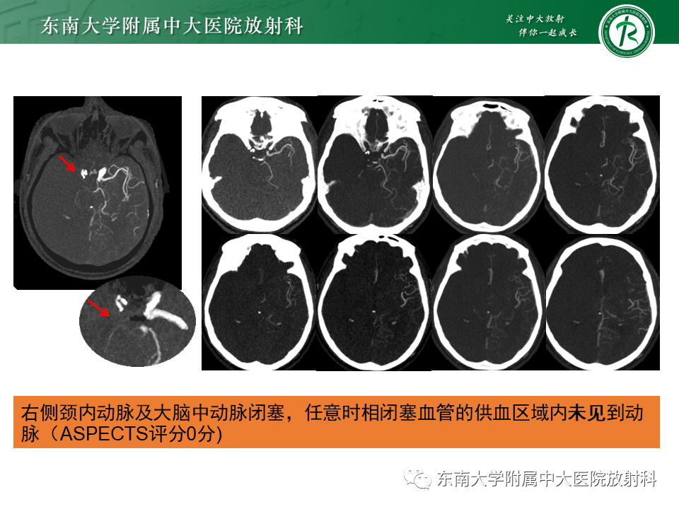 影像PPT - 【PPT】急性缺血性脑卒中的多模态CT评估-34
