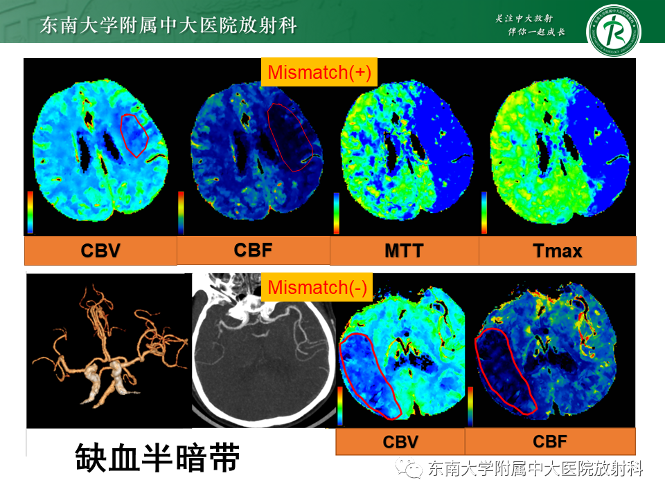 影像PPT - 【PPT】急性缺血性脑卒中的多模态CT评估-41
