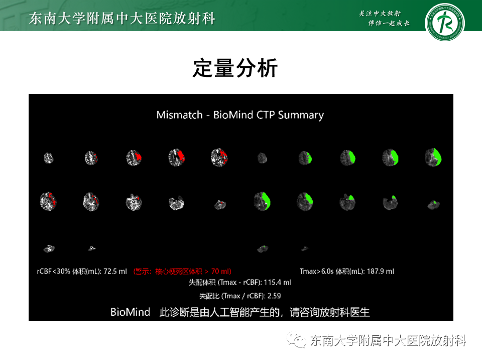 影像PPT - 【PPT】急性缺血性脑卒中的多模态CT评估-44