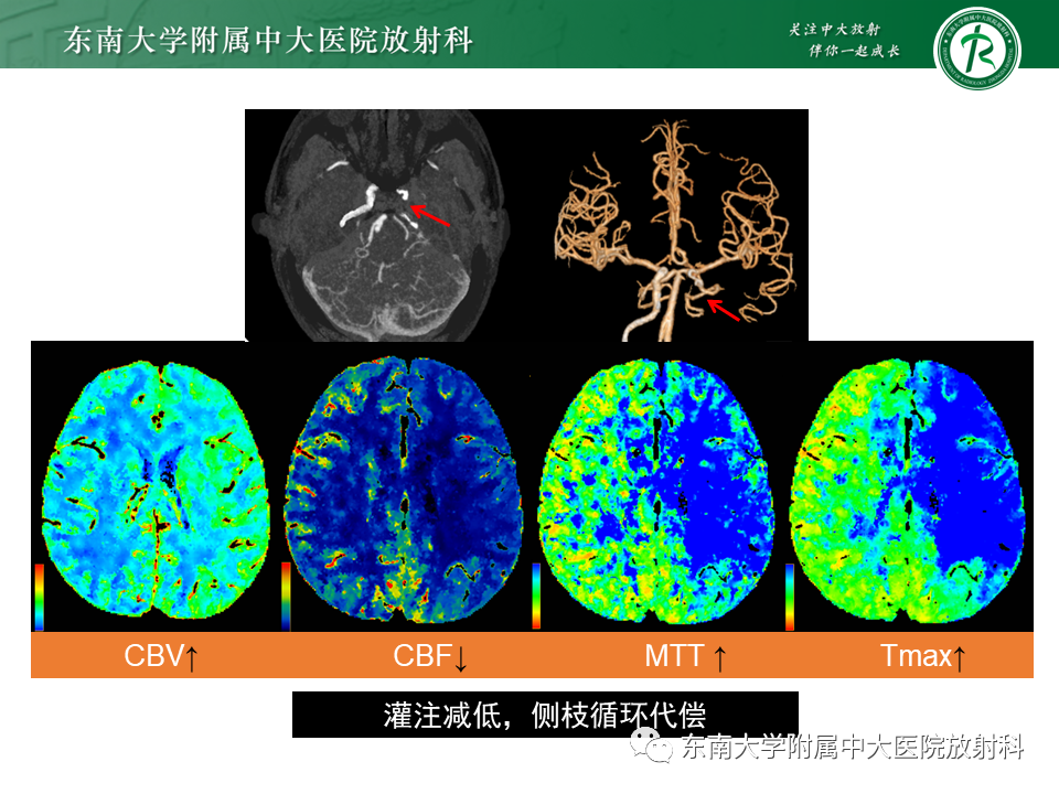 影像PPT - 【PPT】急性缺血性脑卒中的多模态CT评估-46