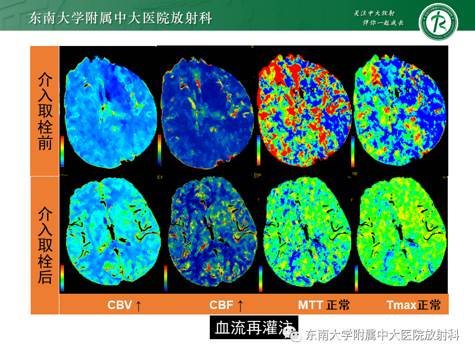影像PPT - 【PPT】急性缺血性脑卒中的多模态CT评估-48