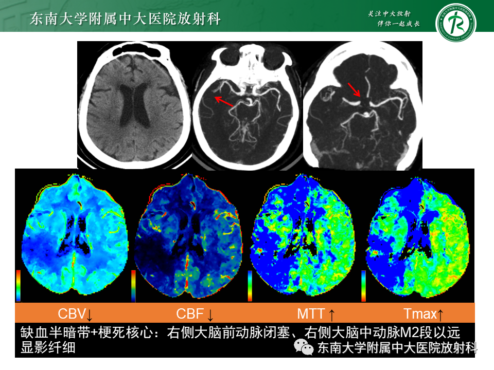 影像PPT - 【PPT】急性缺血性脑卒中的多模态CT评估-47