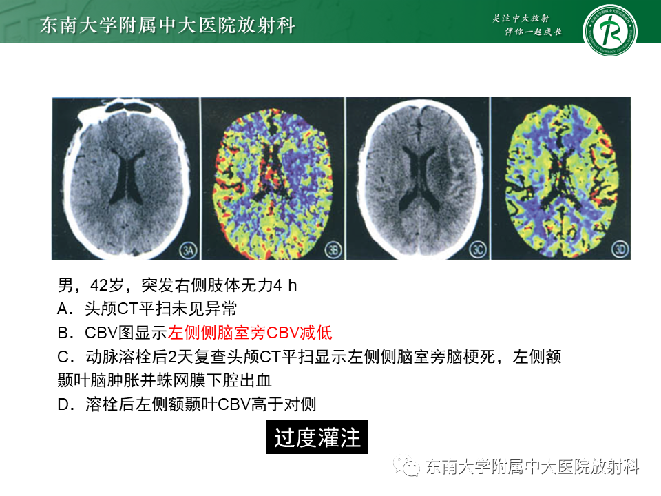 影像PPT - 【PPT】急性缺血性脑卒中的多模态CT评估-49