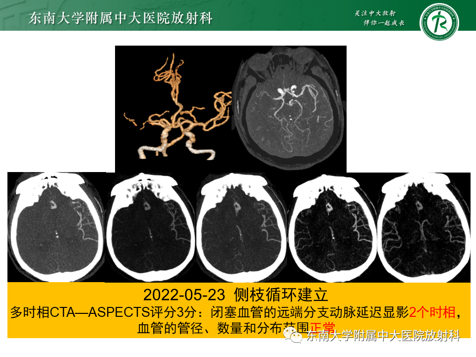 影像PPT - 【PPT】急性缺血性脑卒中的多模态CT评估-51