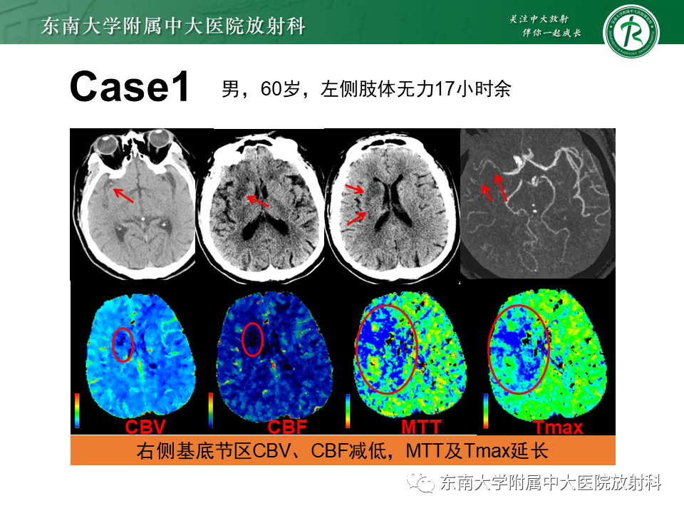 影像PPT - 【PPT】急性缺血性脑卒中的多模态CT评估-50