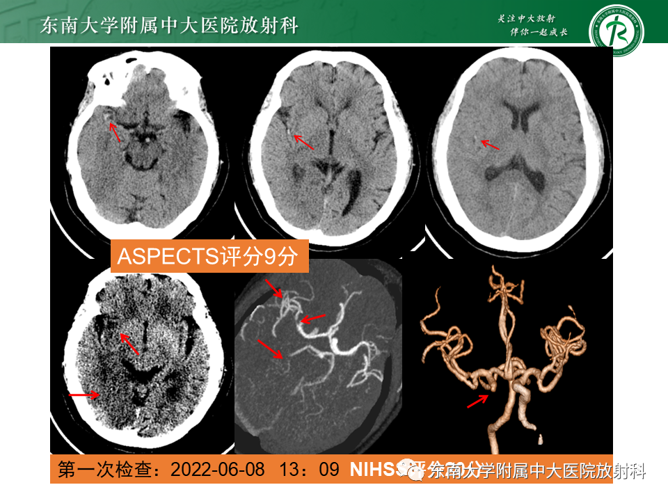 影像PPT - 【PPT】急性缺血性脑卒中的多模态CT评估-54