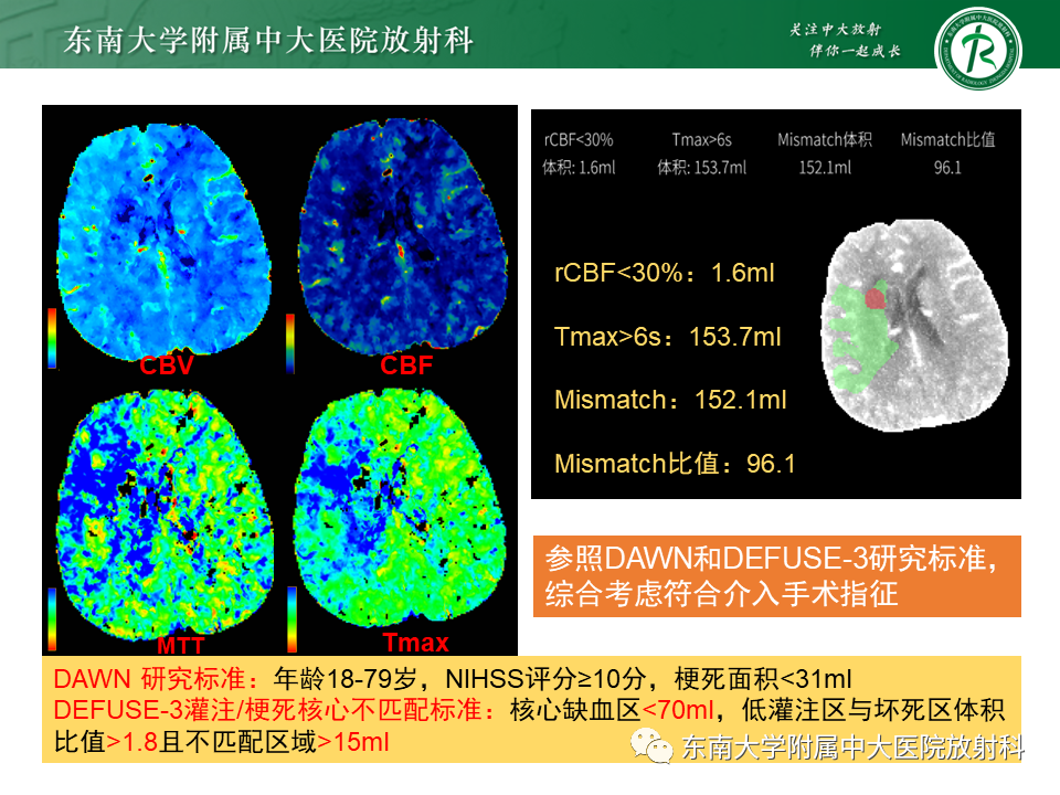 影像PPT - 【PPT】急性缺血性脑卒中的多模态CT评估-52