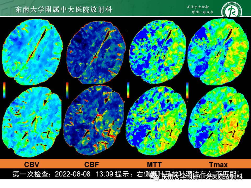 影像PPT - 【PPT】急性缺血性脑卒中的多模态CT评估-55