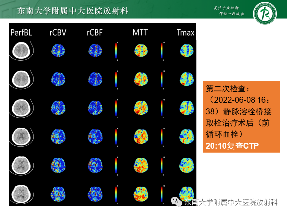 影像PPT - 【PPT】急性缺血性脑卒中的多模态CT评估-58