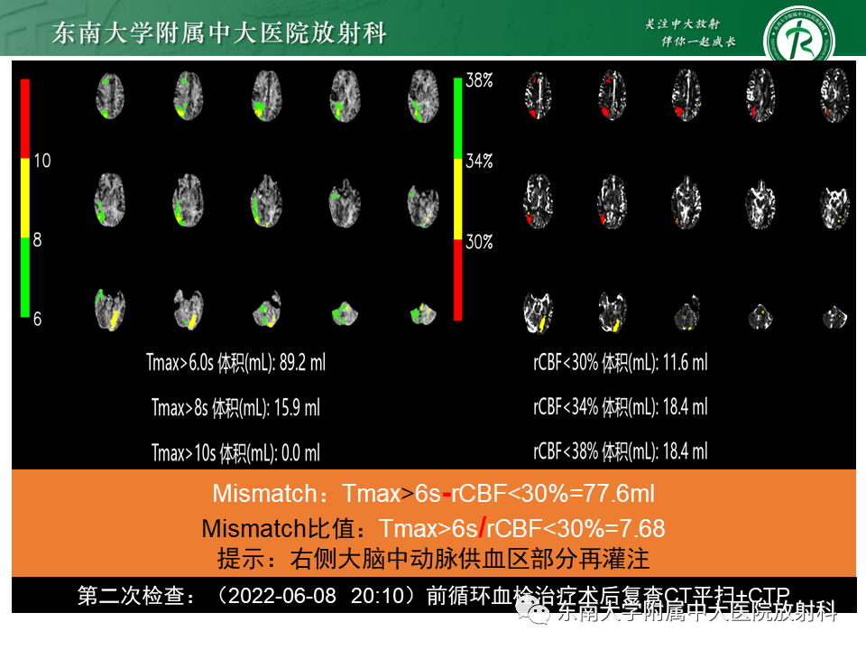 影像PPT - 【PPT】急性缺血性脑卒中的多模态CT评估-59