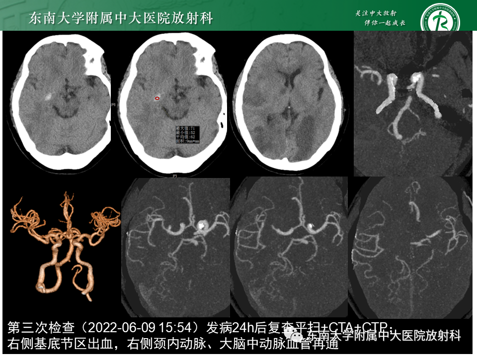 影像PPT - 【PPT】急性缺血性脑卒中的多模态CT评估-60