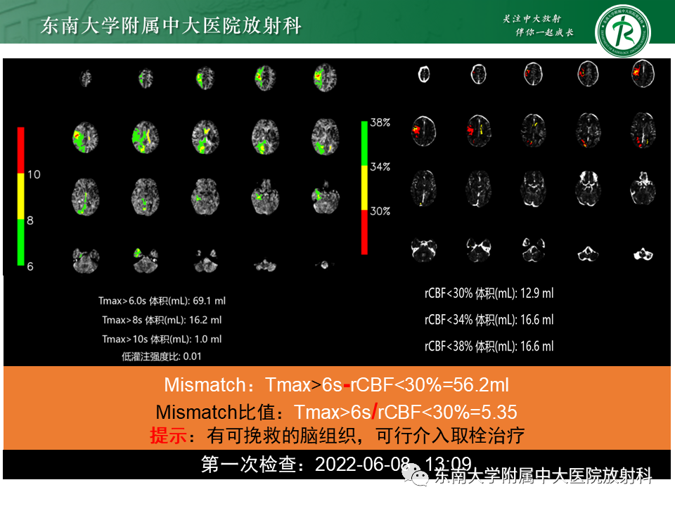 影像PPT - 【PPT】急性缺血性脑卒中的多模态CT评估-56