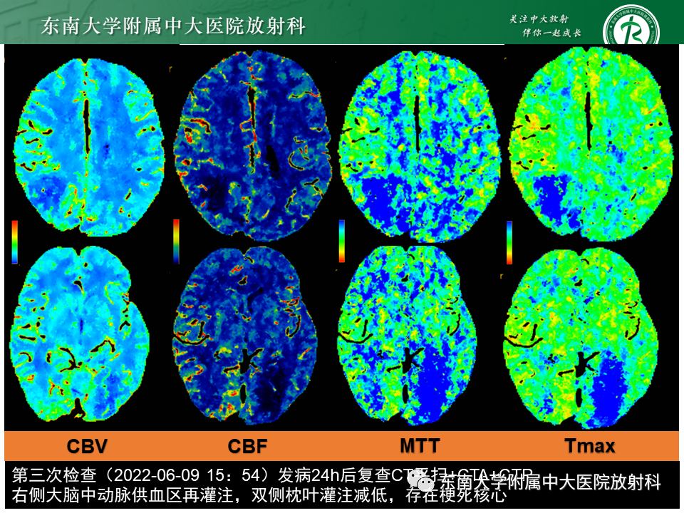影像PPT - 【PPT】急性缺血性脑卒中的多模态CT评估-61