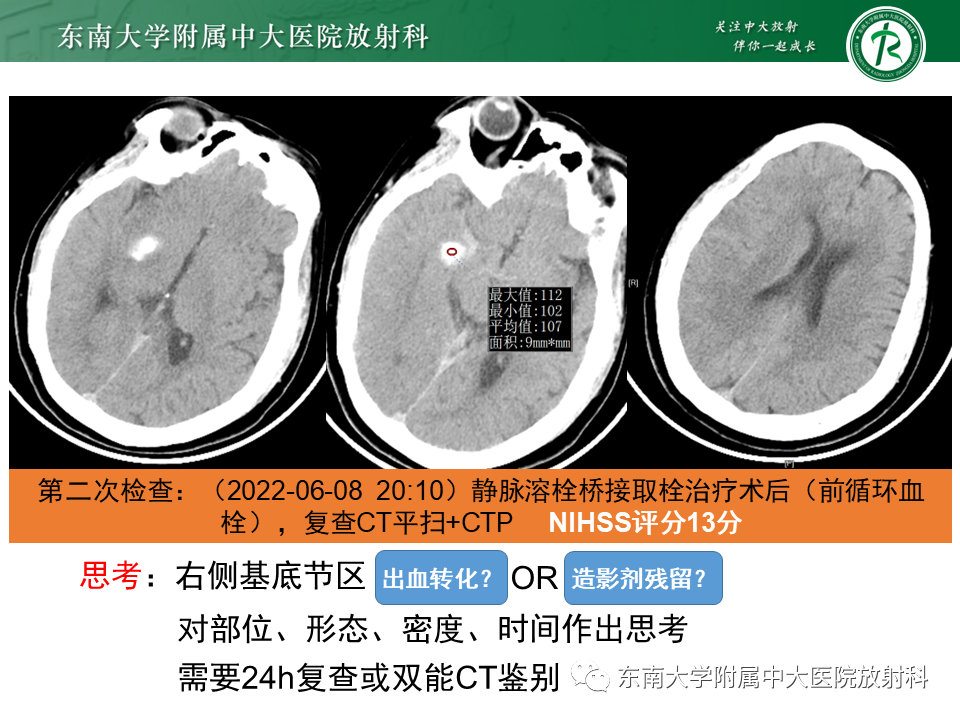 影像PPT - 【PPT】急性缺血性脑卒中的多模态CT评估-57