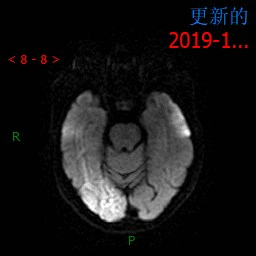 影像PPT - 【病例】MELAS线粒体脑肌病伴高乳酸血症和卒中样发作综合征一例MR-7 影像PPT - 【病例】MELAS线粒体脑肌病伴高乳酸血症和卒中样发作综合征一例MR-7