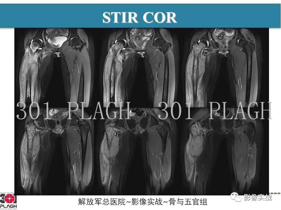影像PPT - 【病例】股骨尤文氏肉瘤/PNET一例-5