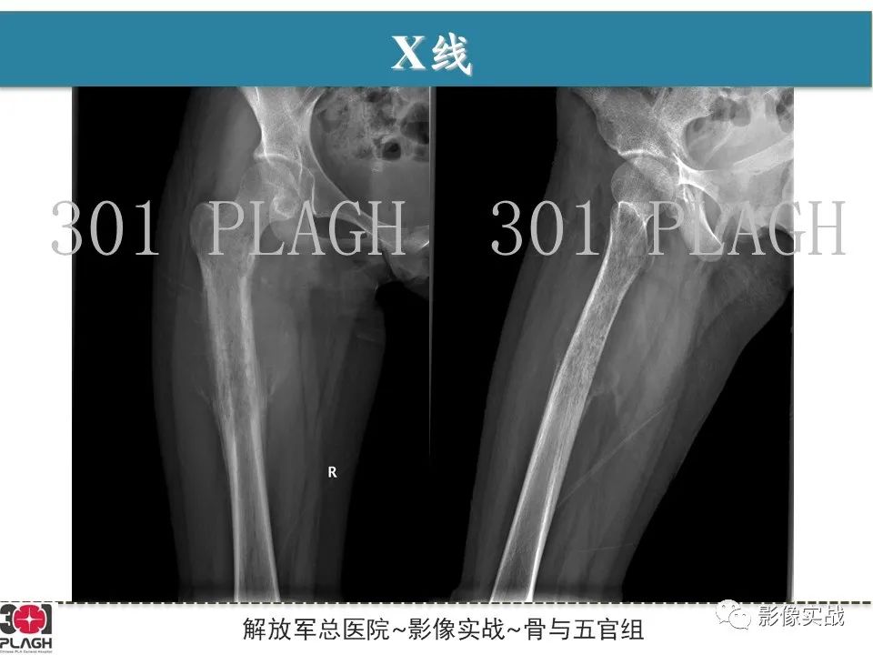影像PPT - 【病例】股骨尤文氏肉瘤/PNET一例-3