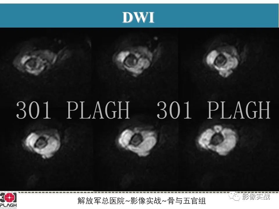 影像PPT - 【病例】股骨尤文氏肉瘤/PNET一例-8