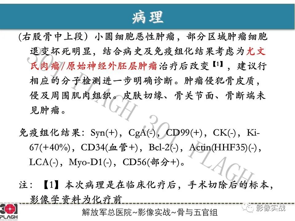 影像PPT - 【病例】股骨尤文氏肉瘤/PNET一例-12